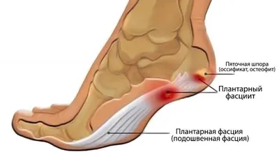 Пяточная шпора: симптомы, причины, диагностика, лечение плантарного  фасциита в Москве