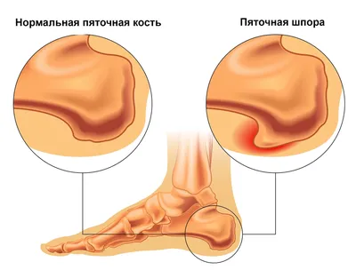 Ударно-волновая терапия при пяточной шпоре | Блог клиники Артромед