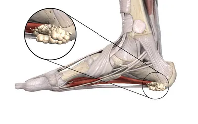 Лечение пяточной шпоры в Киеве - Vertebra