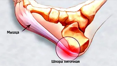 Лечение \"Пяточной шпоры\" — Медицинский центр \"Наш Доктор\" Липецк