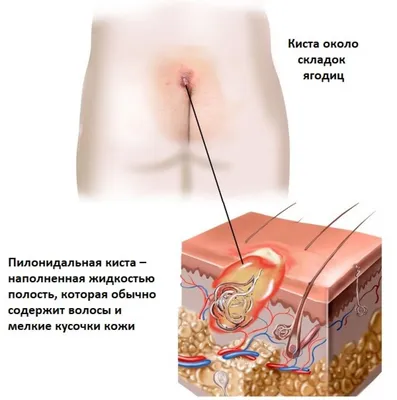 Киста копчика. Эпителиальный копчиковый ход. Кому удаляли кисту на копчике?  ЭКХ | Fermer.Ru - Фермер.Ру - Главный фермерский портал - все о бизнесе в  сельском хозяйстве. Форум фермеров.