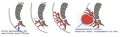 Эпителиальный копчиковый ход: причины воспаления, лечение, операция по  иссечению хода