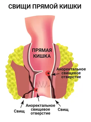 Пилонидальная киста лечение в Екатеринбурге