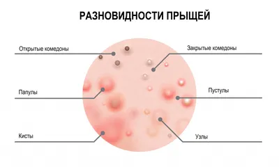 От чего появляются гормональные прыщи: основные причины | ЛЕМАРК