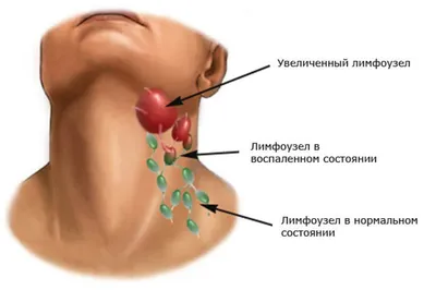 Лимфаденопатия — Википедия